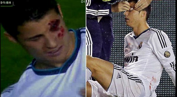 Video: Cristiano Ronaldo se rompió el párpado en partido