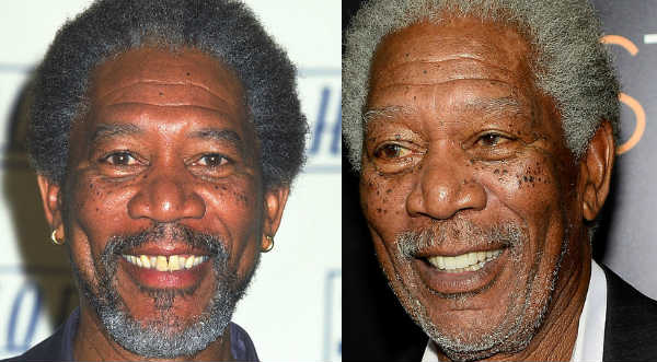 Mira el antes y el después de los famosos que usaron 'brackets'