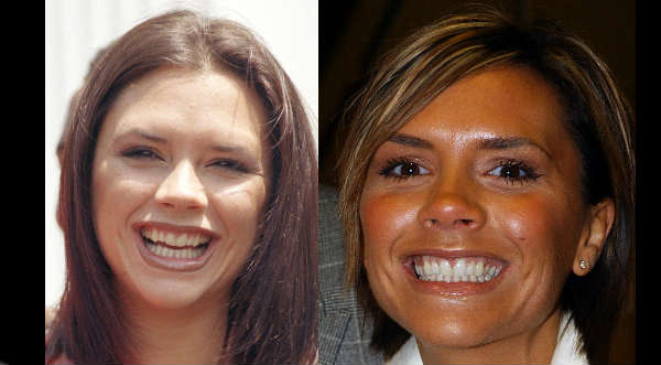Mira el antes y el después de los famosos que usaron 'brackets'