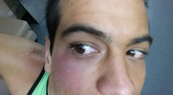 Ernesto Jiménez publica foto de terrible golpe en el rostro- FOTO