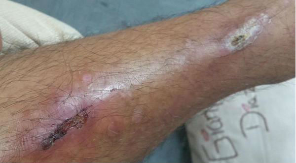 El 'combatiente' Ernesto Jiménez compartió imagen de su terrible herida- FOTO