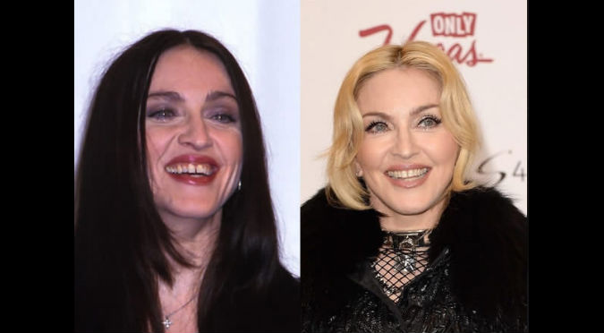 ¡Irreconocibles! Así eran estas celebridades antes de lucir dientes perfectos – FOTOS