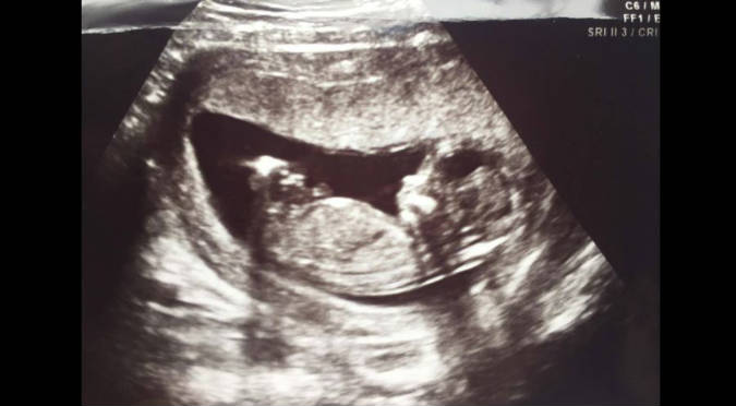 Que Bonito Yidda Eslava Y Julian Zucchi Publican La Ecografia De Su Bebe Fotos Farandula Radio Onda Cero