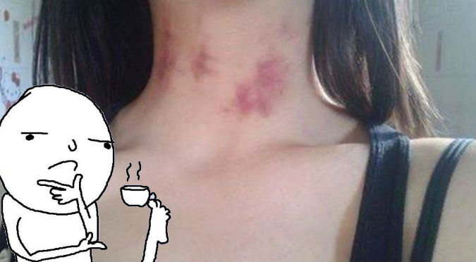 Viral: Le 'chupetearon' en el cuello y así se excusó con su enamorado - FOTO