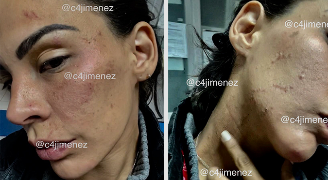 Stephanie Valenzuela muestra su rostro desfigurado tras denunciar golpiza de Eleazar Gómez