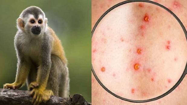 Minsa declara alerta sanitaria por la posible llegada viruela del mono al Perú | VIDEO
