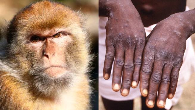 Viruela del mono en Perú: el 96% de contagiados tiene esta opción sexual | VIDEO