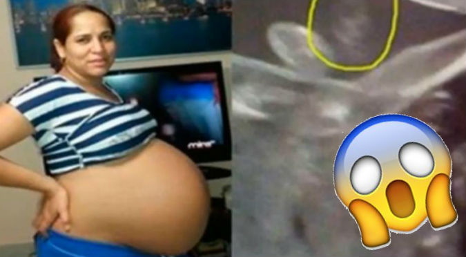 YouTube: Tiene 18 meses de embarazo y los doctores descubrieron…