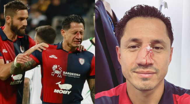 ¡Otra vez! Gianluca Lapadula volvió a sufrir un terrible golpe en la nariz y así quedo su rostro